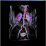 Medical Visualization of a MR Angiography with Inverse Gradient-Magnitude Volume Rendering