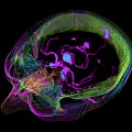 Medical Visualization of an Aneurysm with Spatial Transfer-Functions
