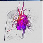 Medical Visualization of a MR Angiography with Standard Gradient-Magnitude Volume Rendering and Backlight