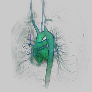 Aorta-Subclavia