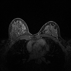 Tumor-MIPt